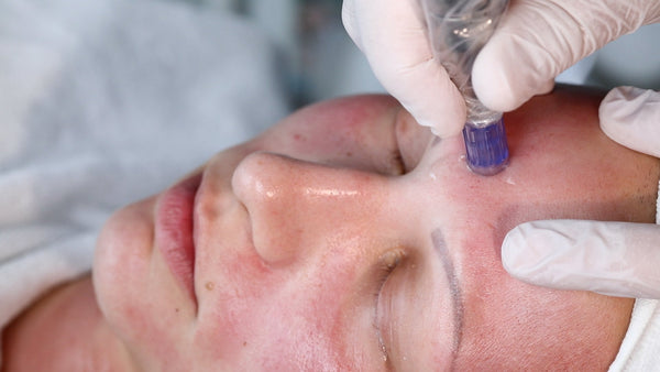 Beauty Ratenzahlung für Micro - Needling - Finanzierungsoptionen - BeautySeele