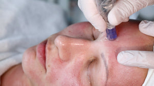 Beauty Ratenzahlung für Micro - Needling - Finanzierungsoptionen - BeautySeele